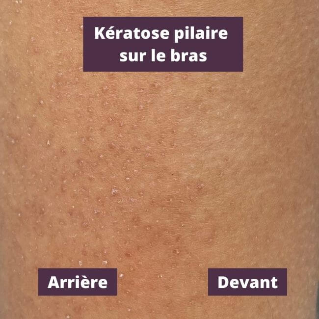 Traiter la Kératose Pilaire : la Fin des Petits Boutons - IN'OYA